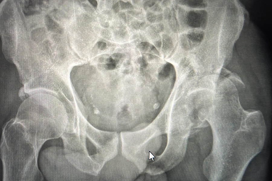 Fracture dislocation of the Left Hip