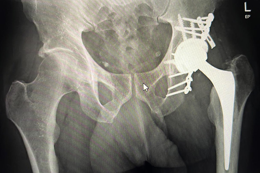 Reconstruction of Left Socket and Hip Replacement