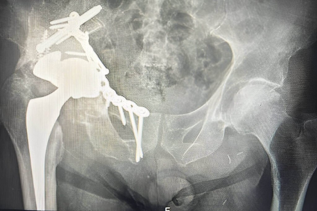 82 year old Acetabular fracture treated with fracture fixation and complex total replacement